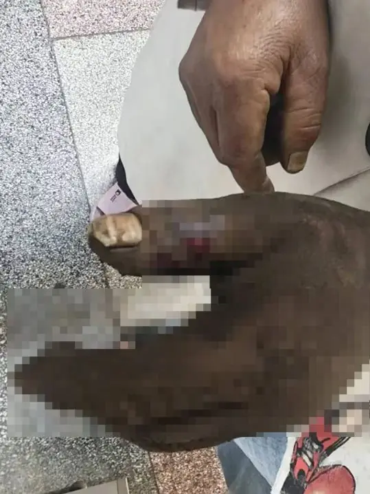 一大爷被蛇咬伤，老伴情急之下用嘴吸蛇毒，结果双双紧急送医抢救