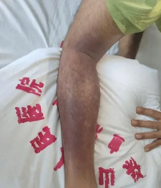 云南男子深山遭3条竹叶青围攻：咬伤12处险些丧命！