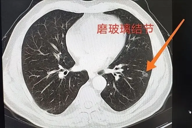 黄瓜被点名了！发现：肺结节病人吃黄瓜，不必等多久，或有5变化